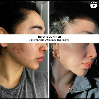 Red Light Therapy Mask | FDA 510(k) Cleared