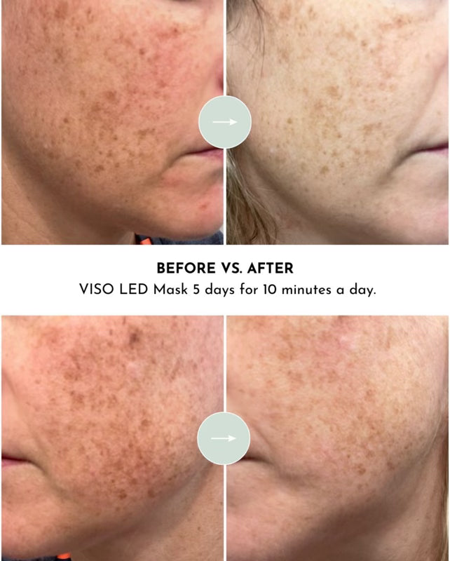 Red Light Therapy Mask | FDA 510(k) Cleared